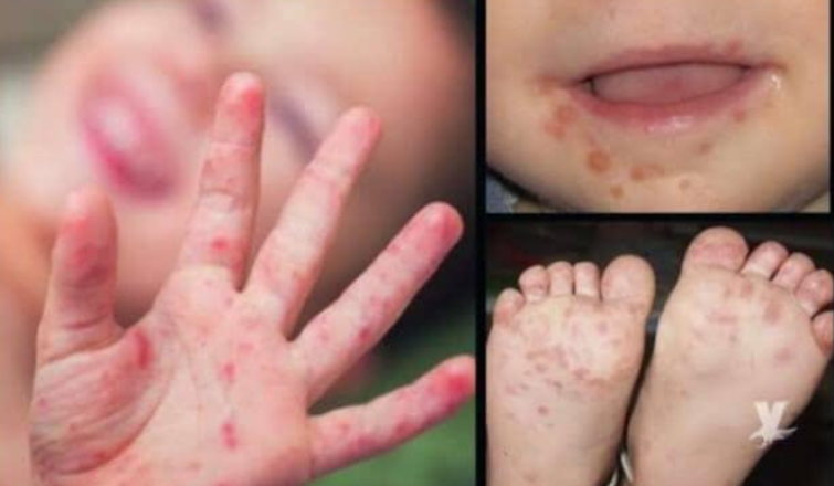 Infección en bebés